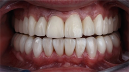 image-filters-teeth-photo